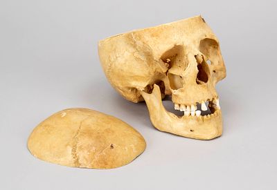 Anatomical teaching model of a human skull, 20th century, original. Lower jaw loose, skull cap 