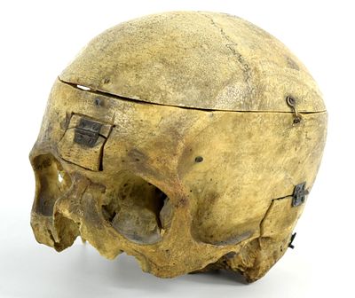 This is antique English 19th Century medical human skull. The skull has a cut calvarium and a 